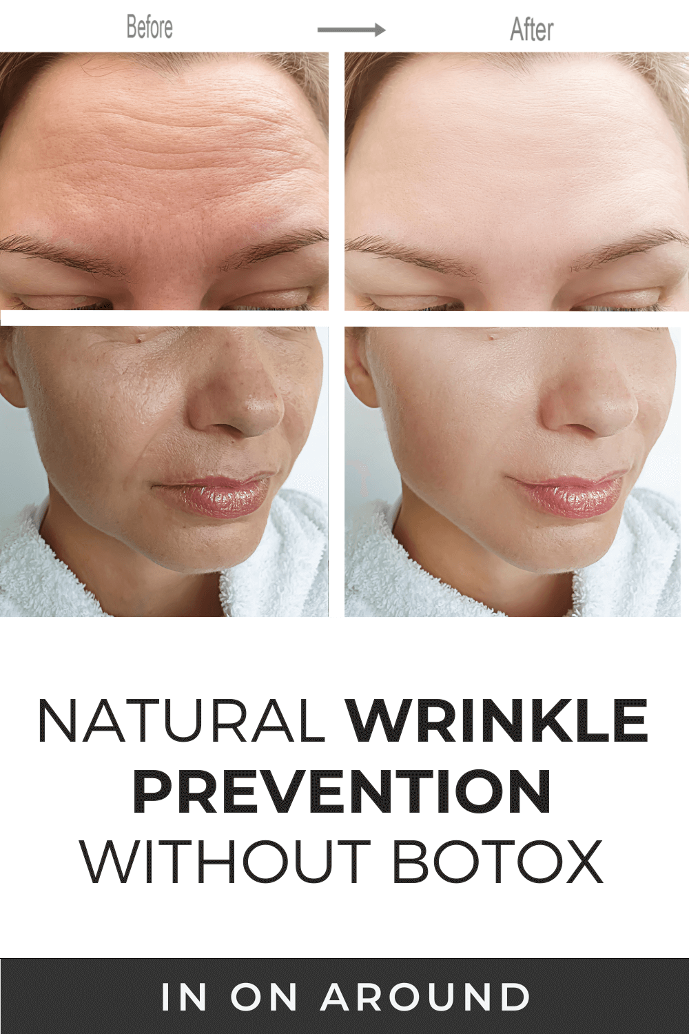 Alternatives To Botox Wrinkles